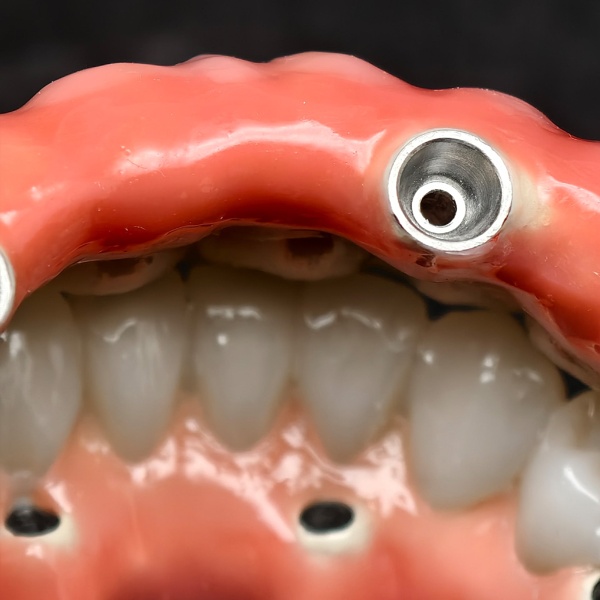 Enhanced Zirconia Crown Malo Bridge