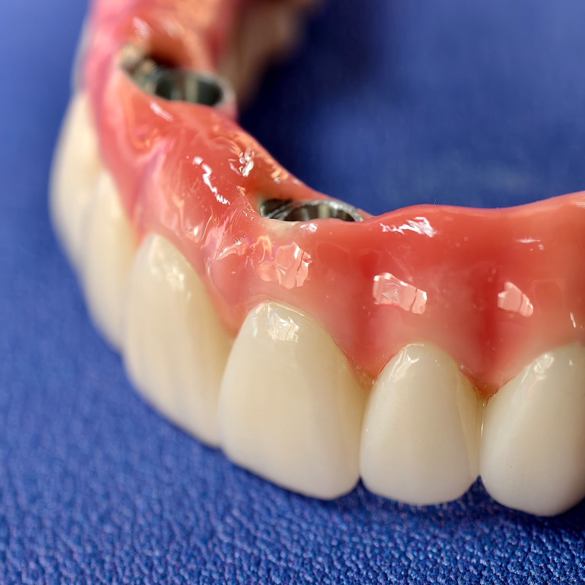 Enhanced Zirconia Crown Malo Bridge