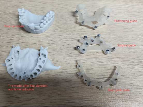 Full Surgical Guide Plate, Used For Bone Reduction Surgery
