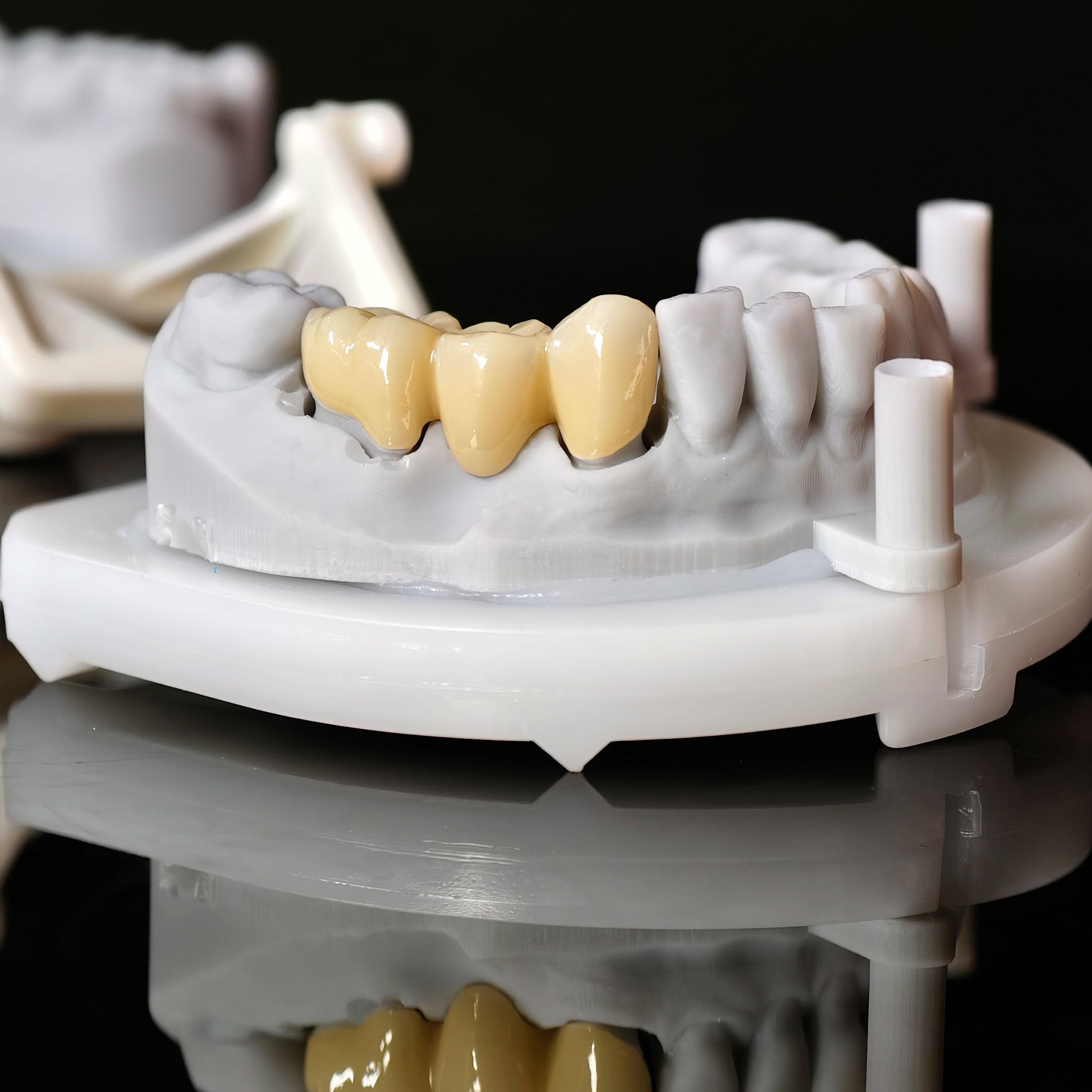 High - Strength Zirconia Bridge