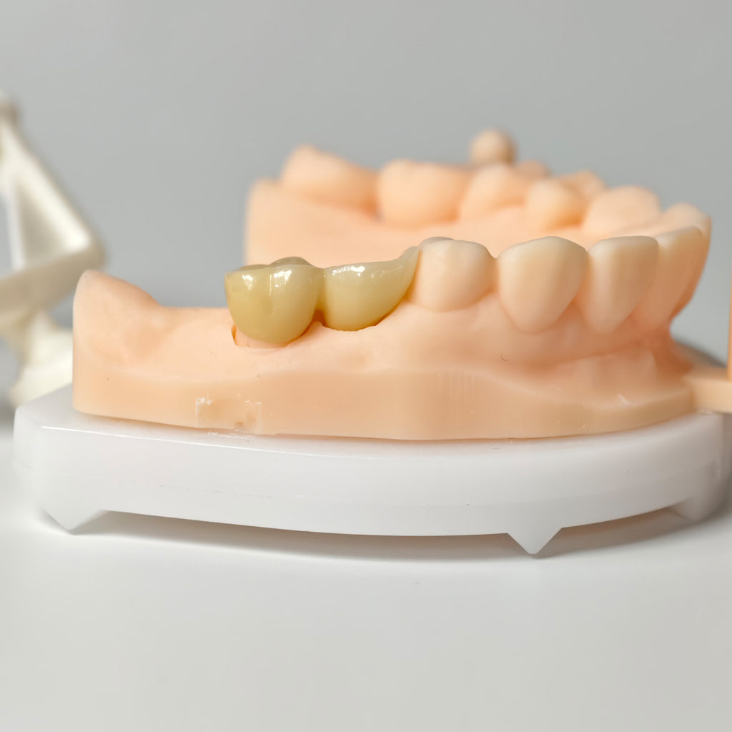 High - Strength Zirconia Bridge