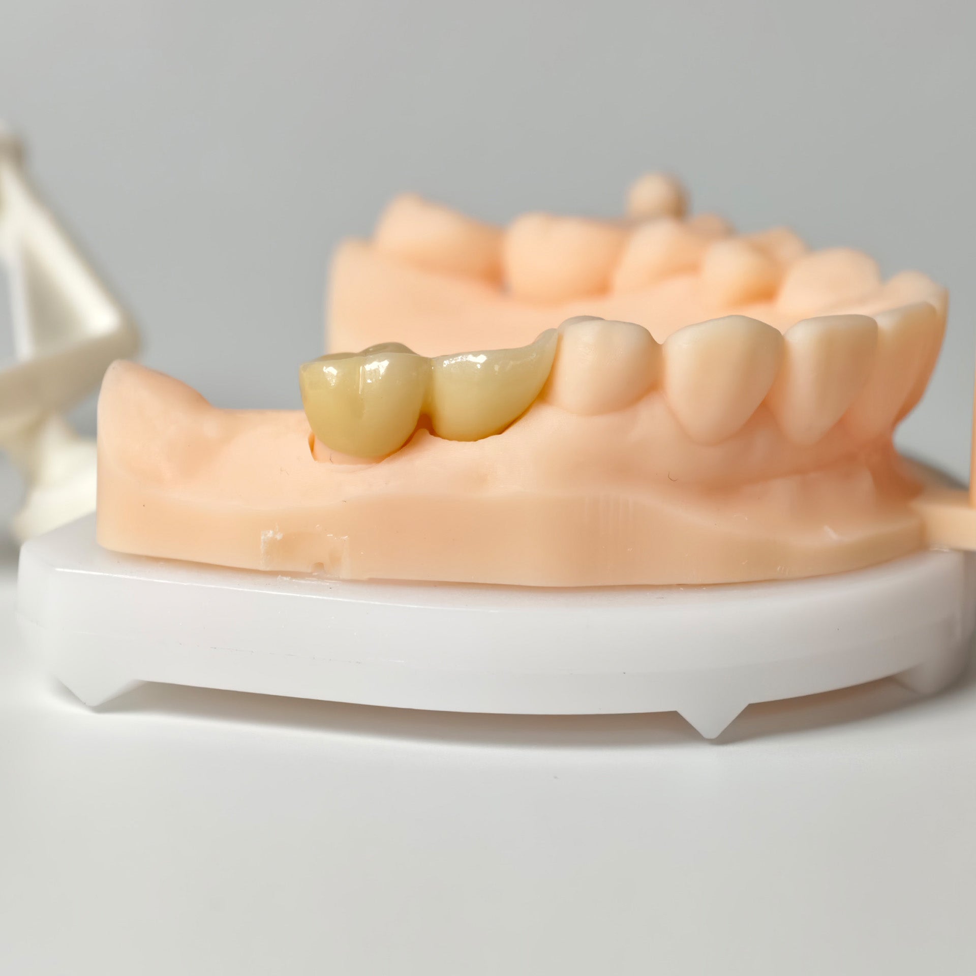 High - Strength Zirconia Bridge