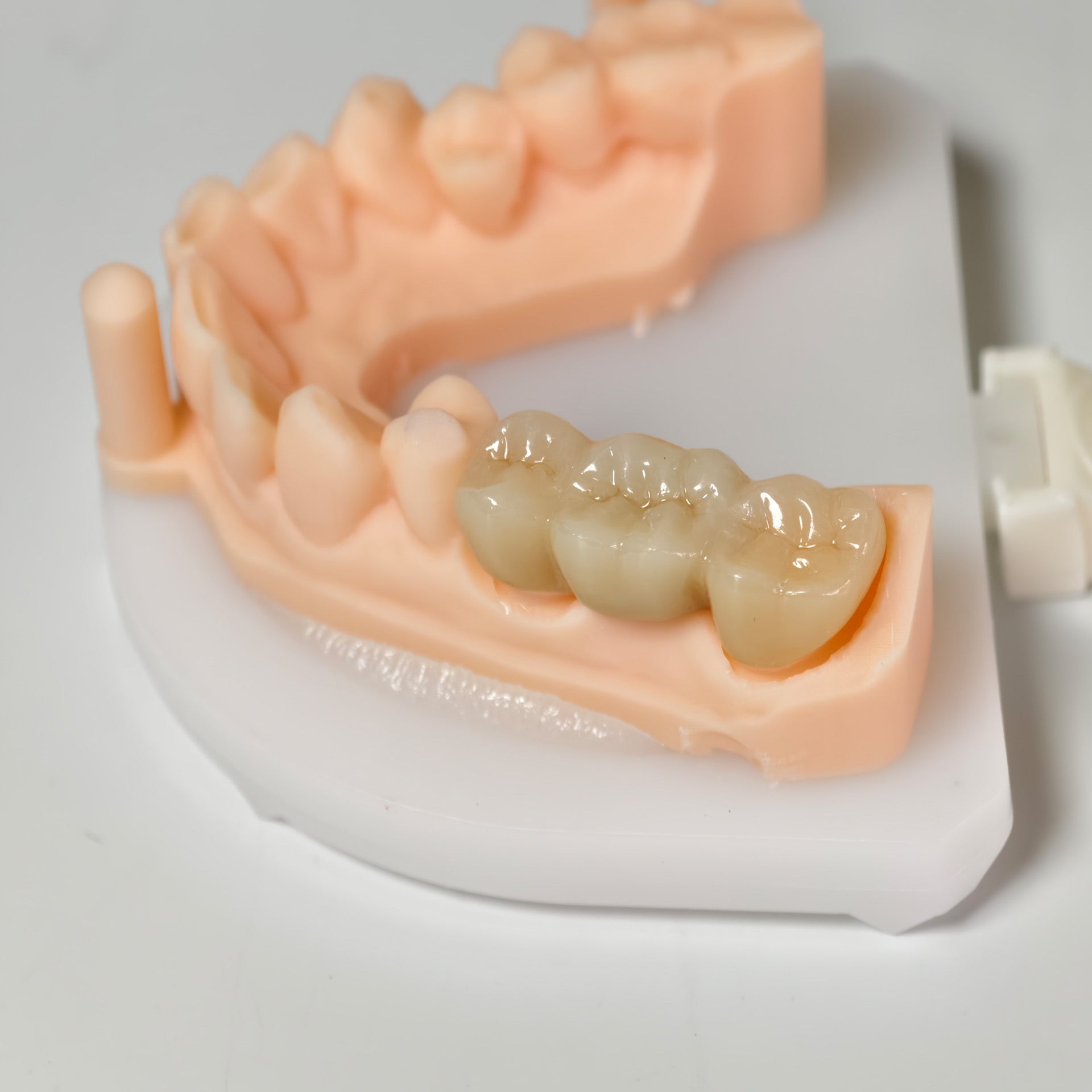High - Strength Zirconia Bridge