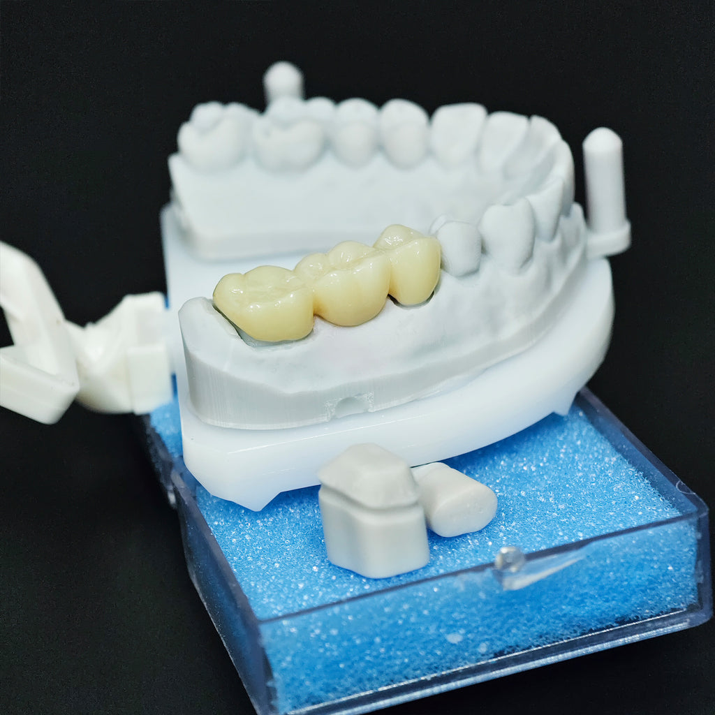 High - Strength Zirconia Bridge