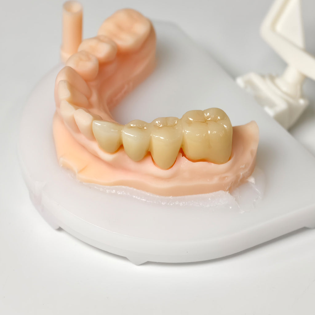High - Strength Zirconia Bridge