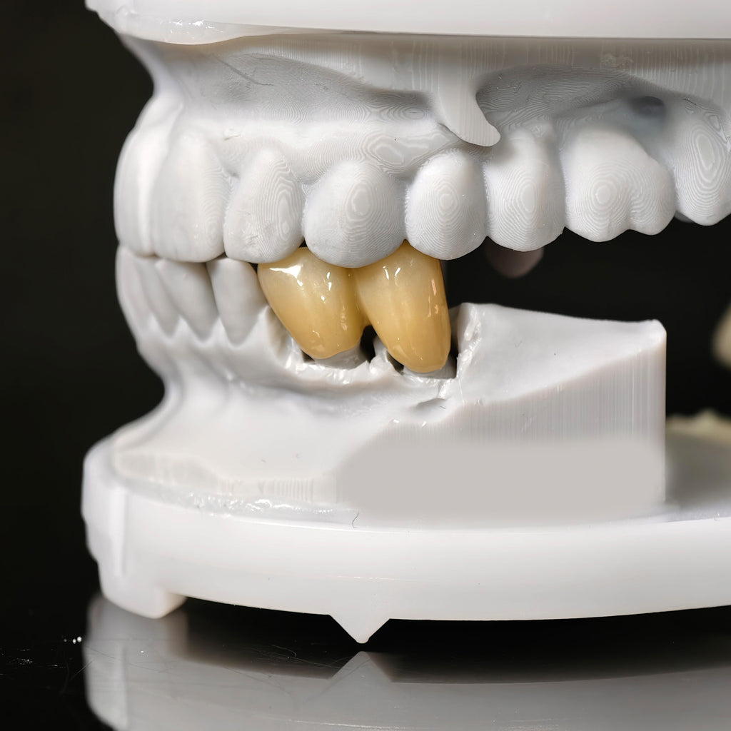 High - Strength Zirconia Bridge