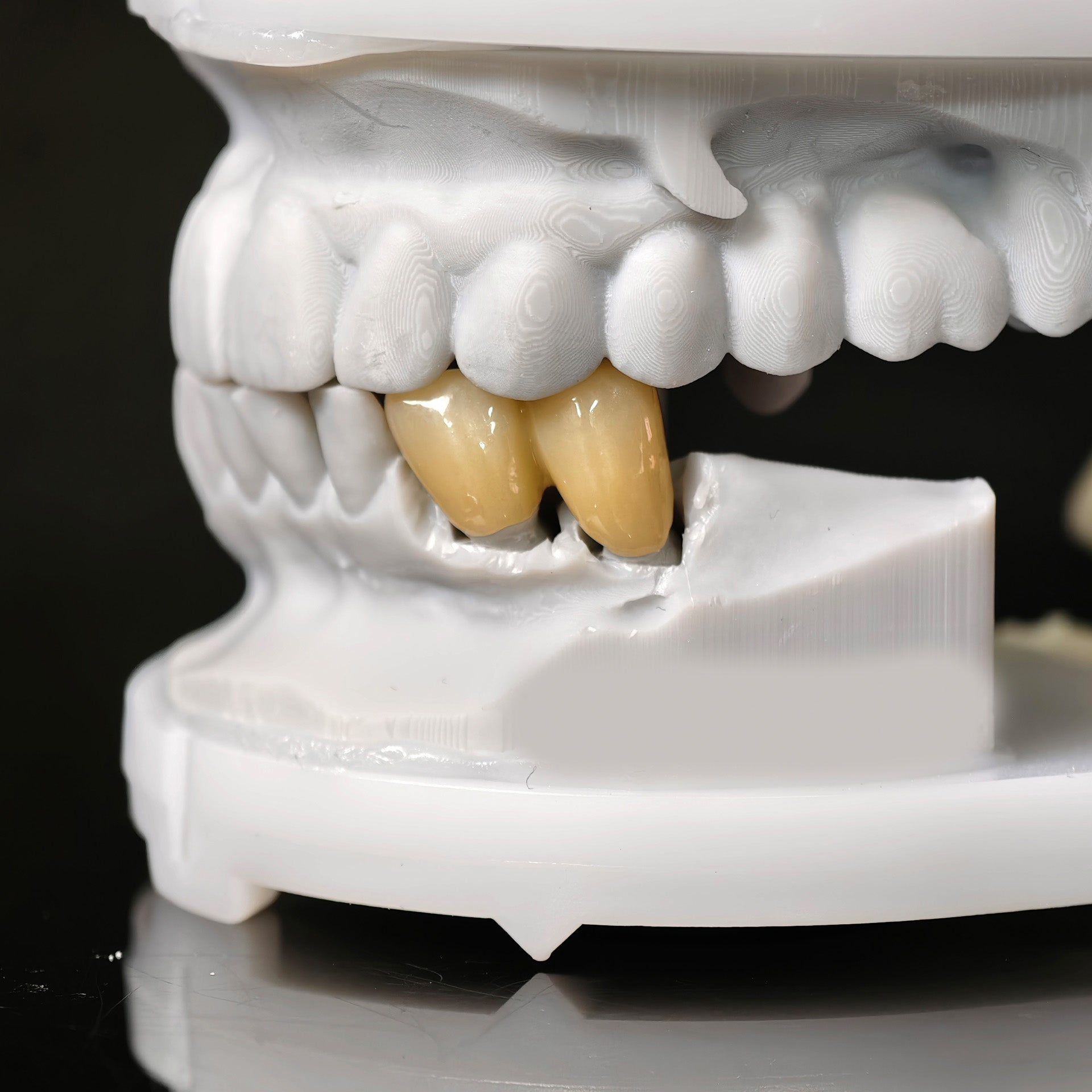 High - Strength Zirconia Bridge