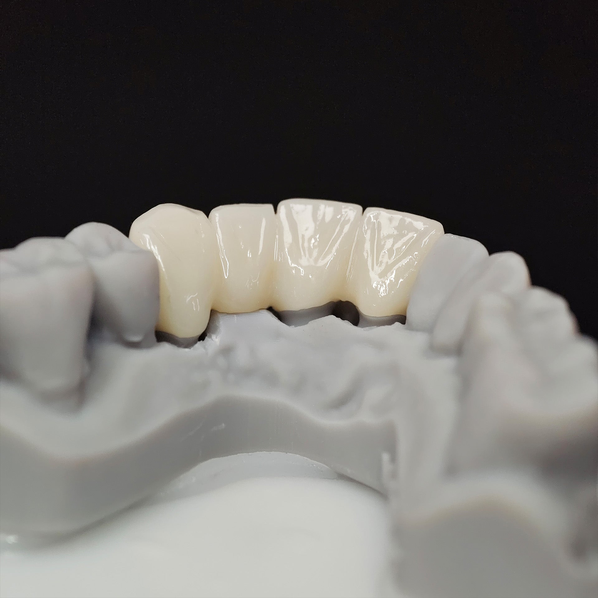 High - Strength Zirconia Bridge