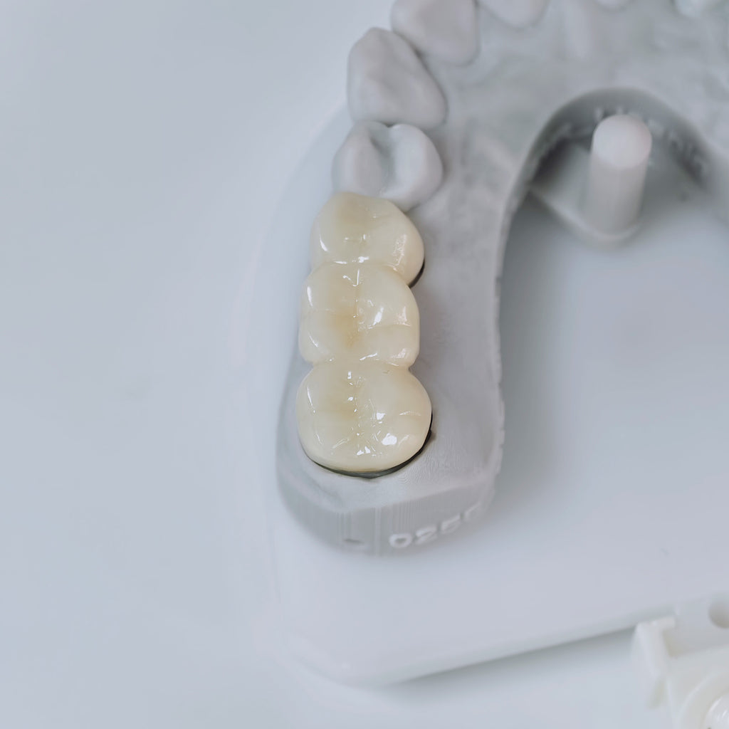 High - Strength Zirconia Bridge