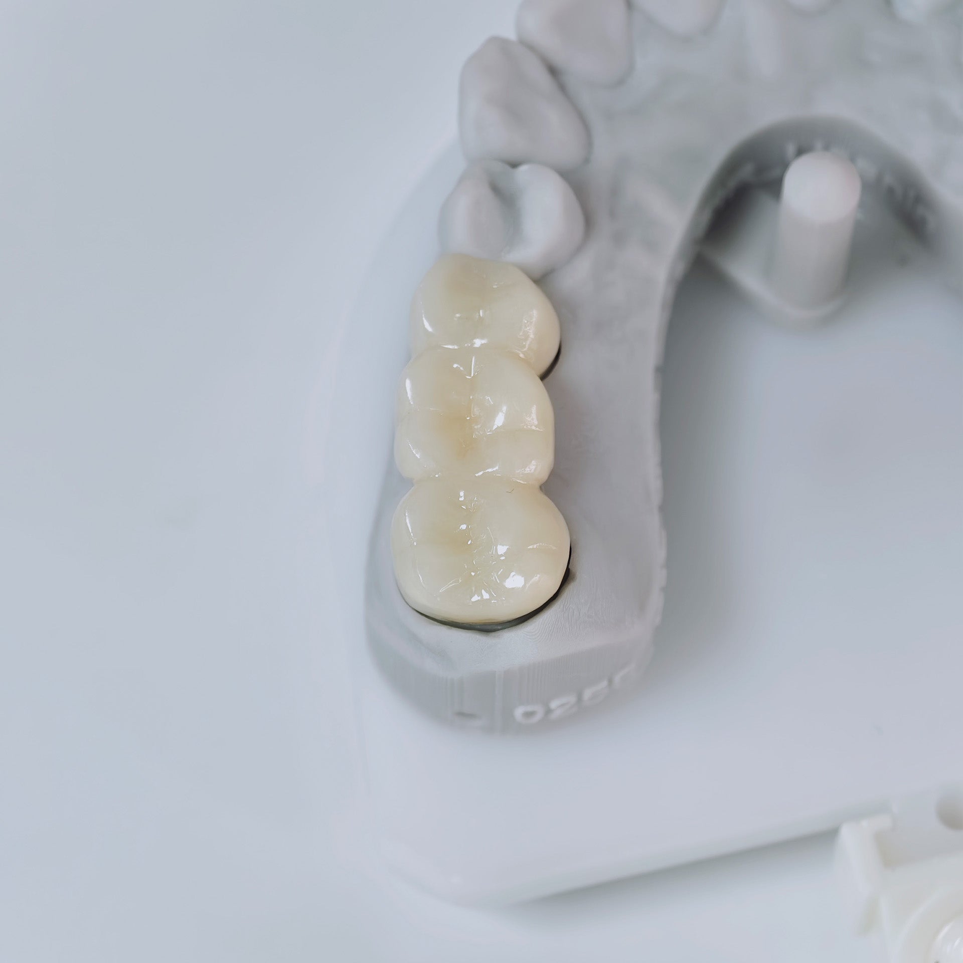 High - Strength Zirconia Bridge