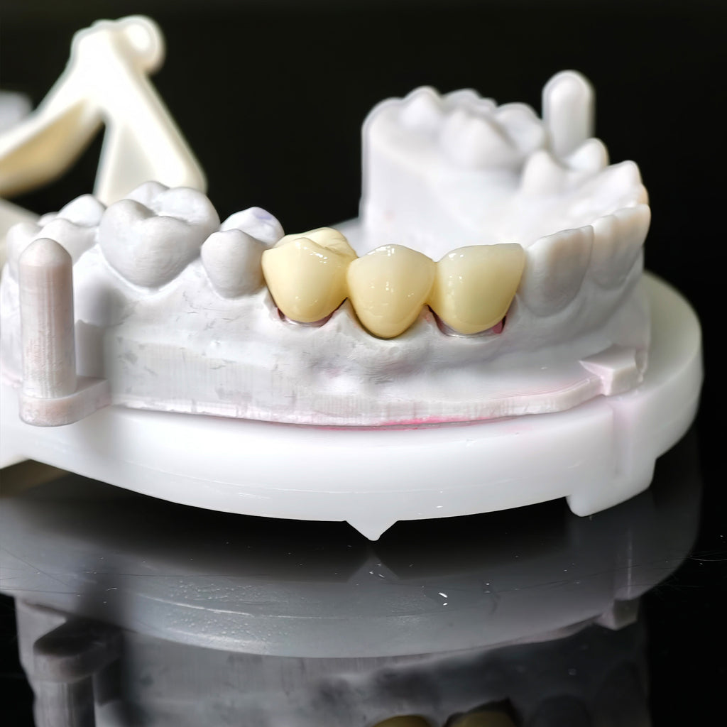 High - Strength Zirconia Bridge