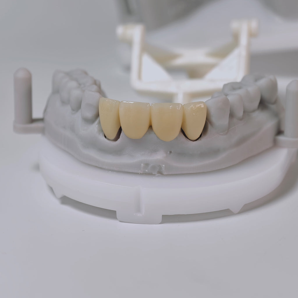 High - Strength Zirconia Bridge