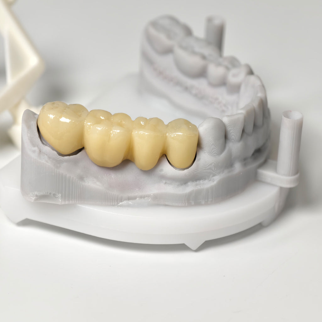 High - Strength Zirconia Bridge