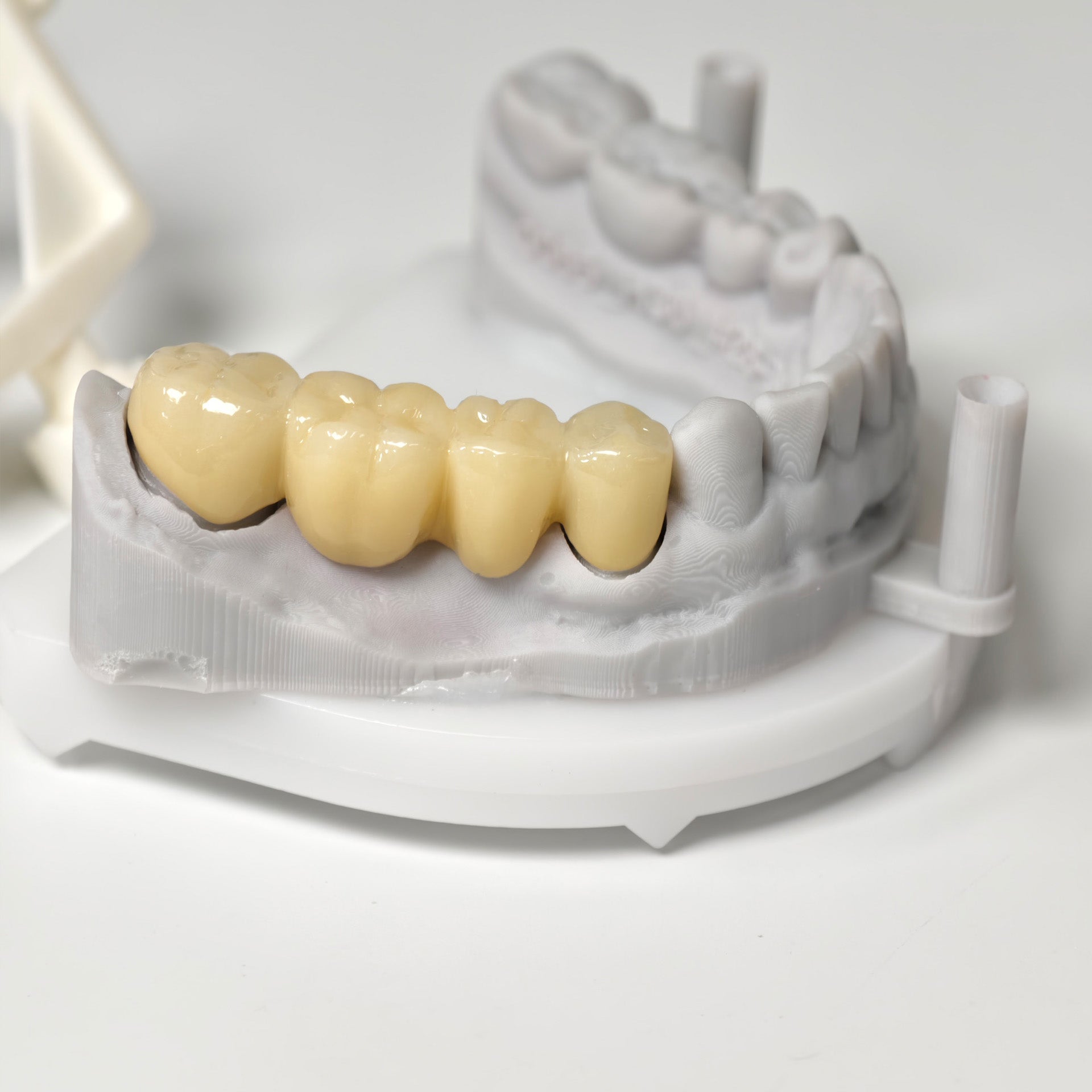 High - Strength Zirconia Bridge