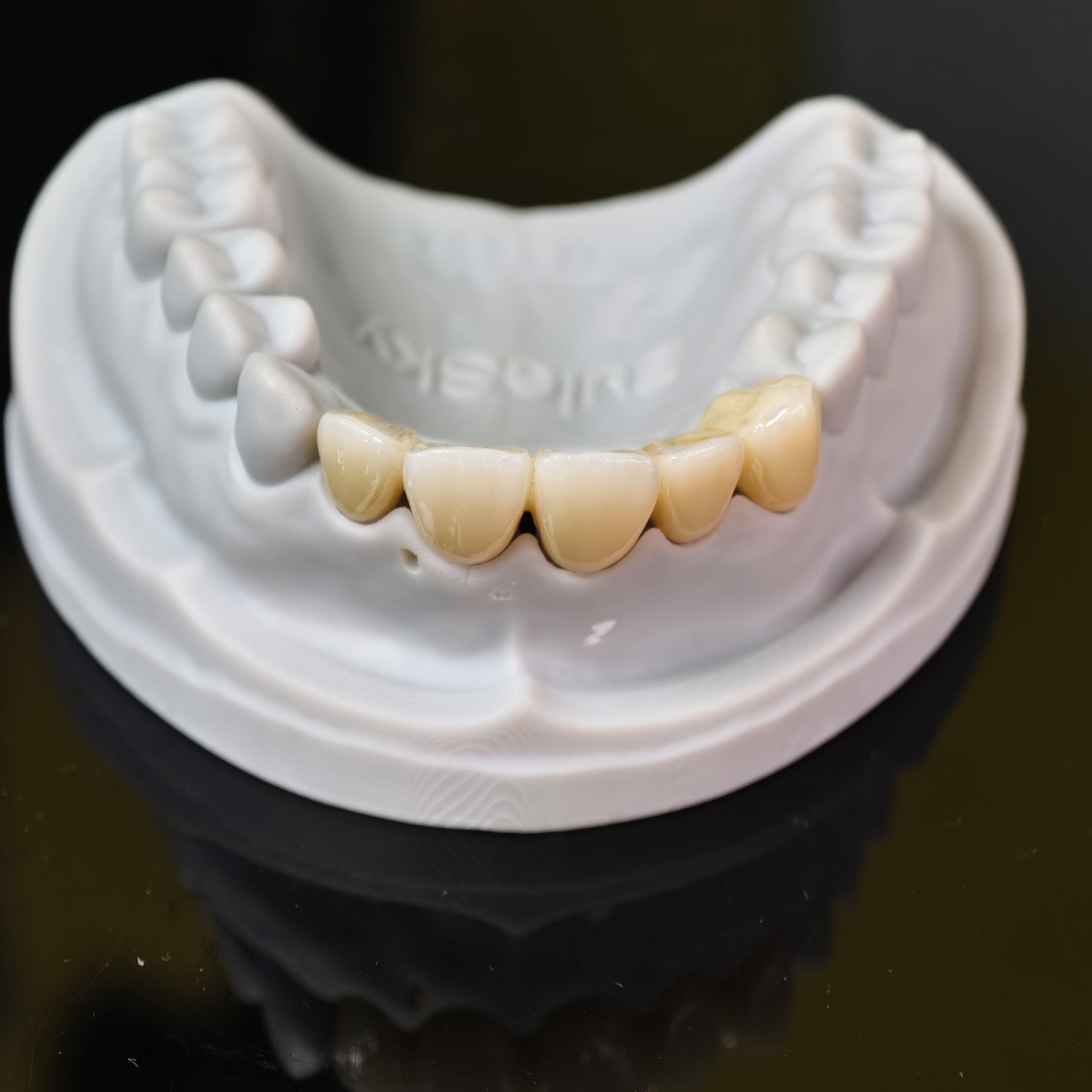 High - Strength Zirconia Bridge