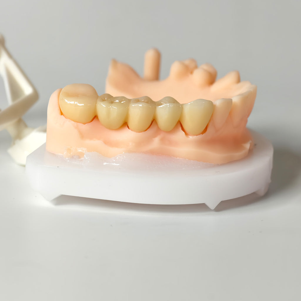 High - Strength Zirconia Bridge