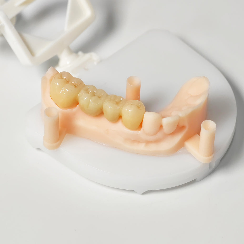 High - Strength Zirconia Bridge