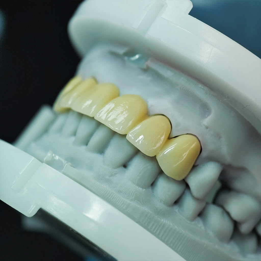 High - Strength Zirconia Bridge