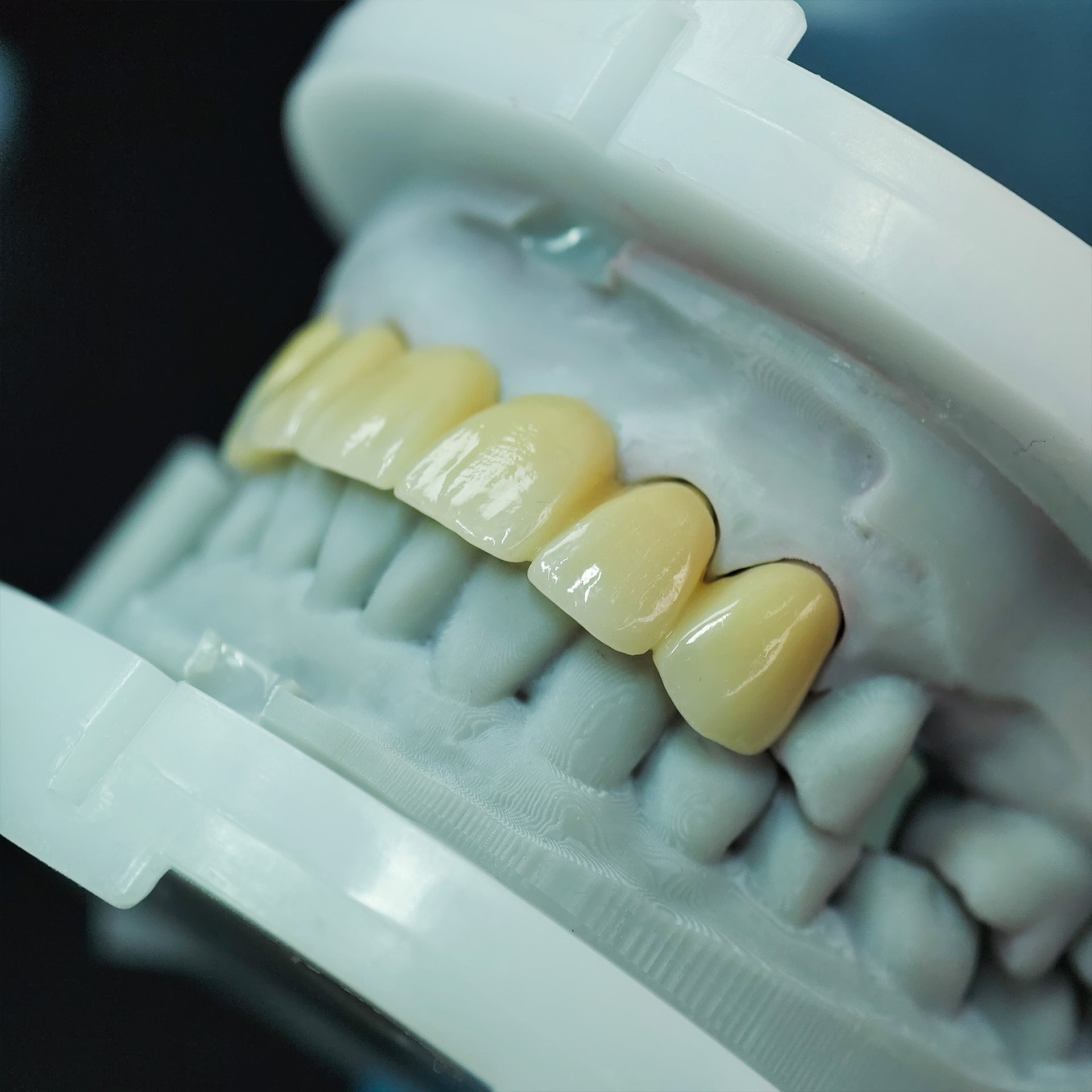 High - Strength Zirconia Bridge