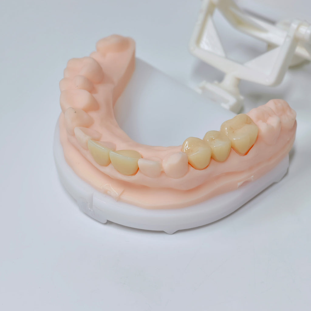High - Strength Zirconia Crowns