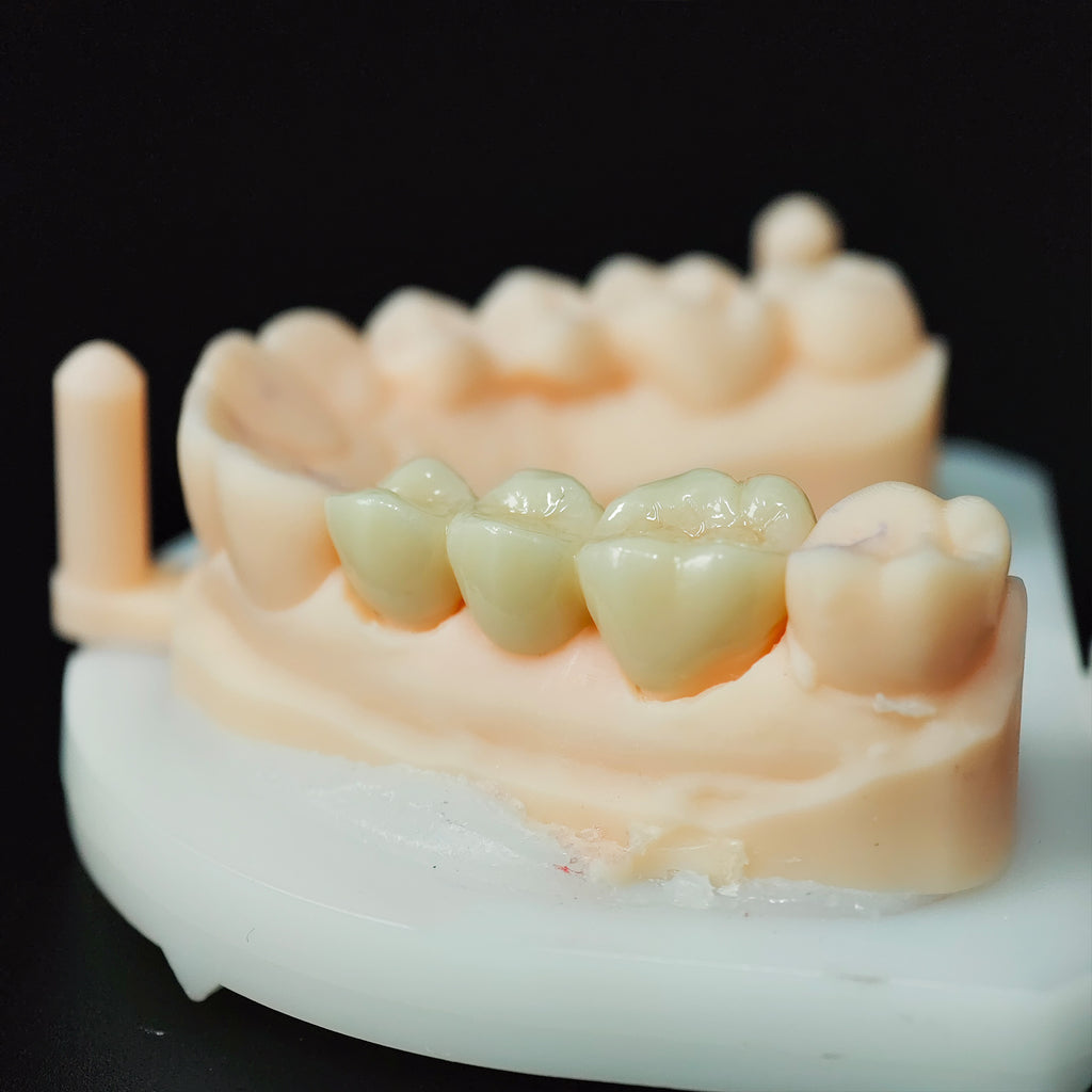 High - Strength Zirconia Bridge