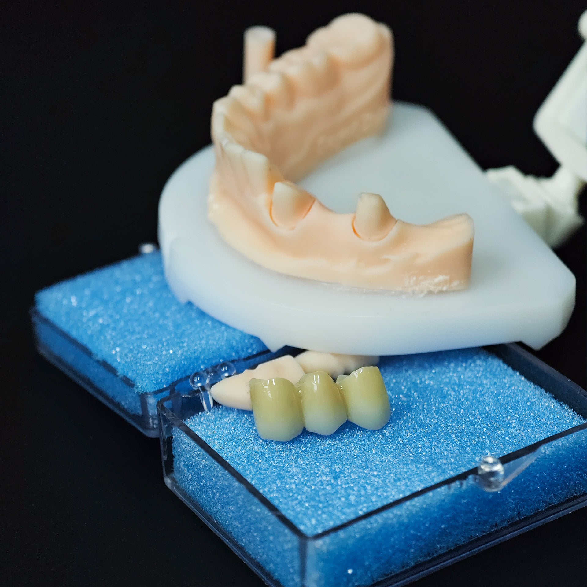 High - Strength Zirconia Bridge