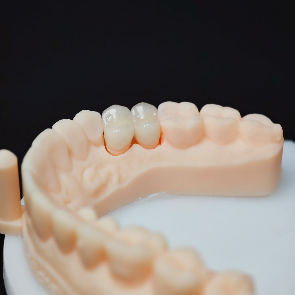 High - Strength Zirconia Crowns
