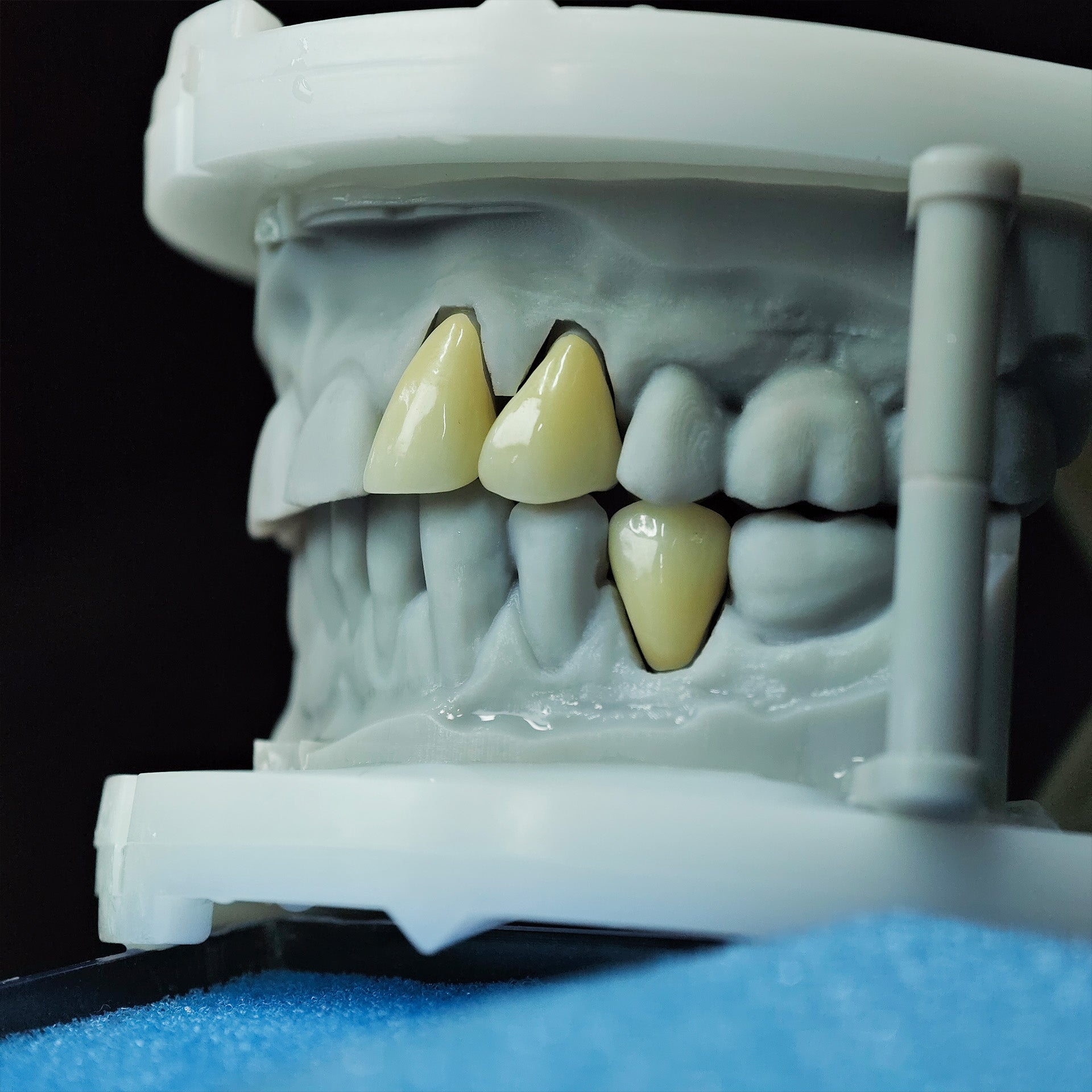 High - Strength Zirconia Crowns