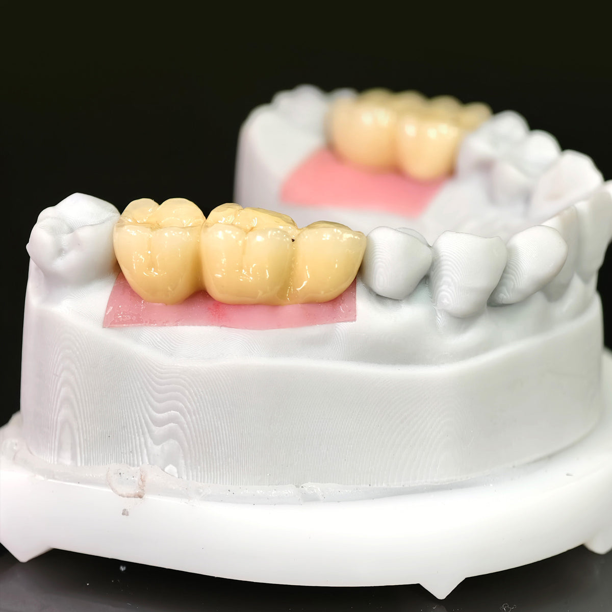 Implant-supported Co - Cr PFM Dental Bridge