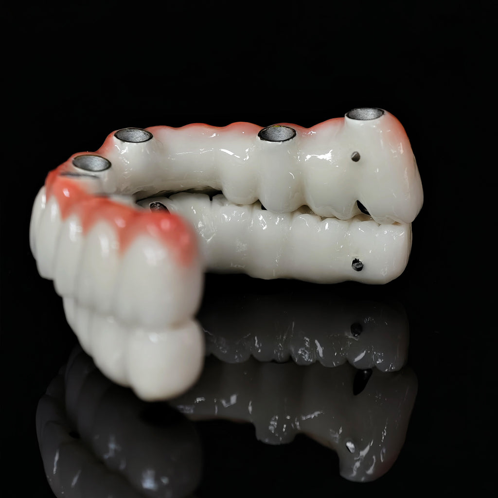 Implant-supported Co - Cr PFM Dental Bridge