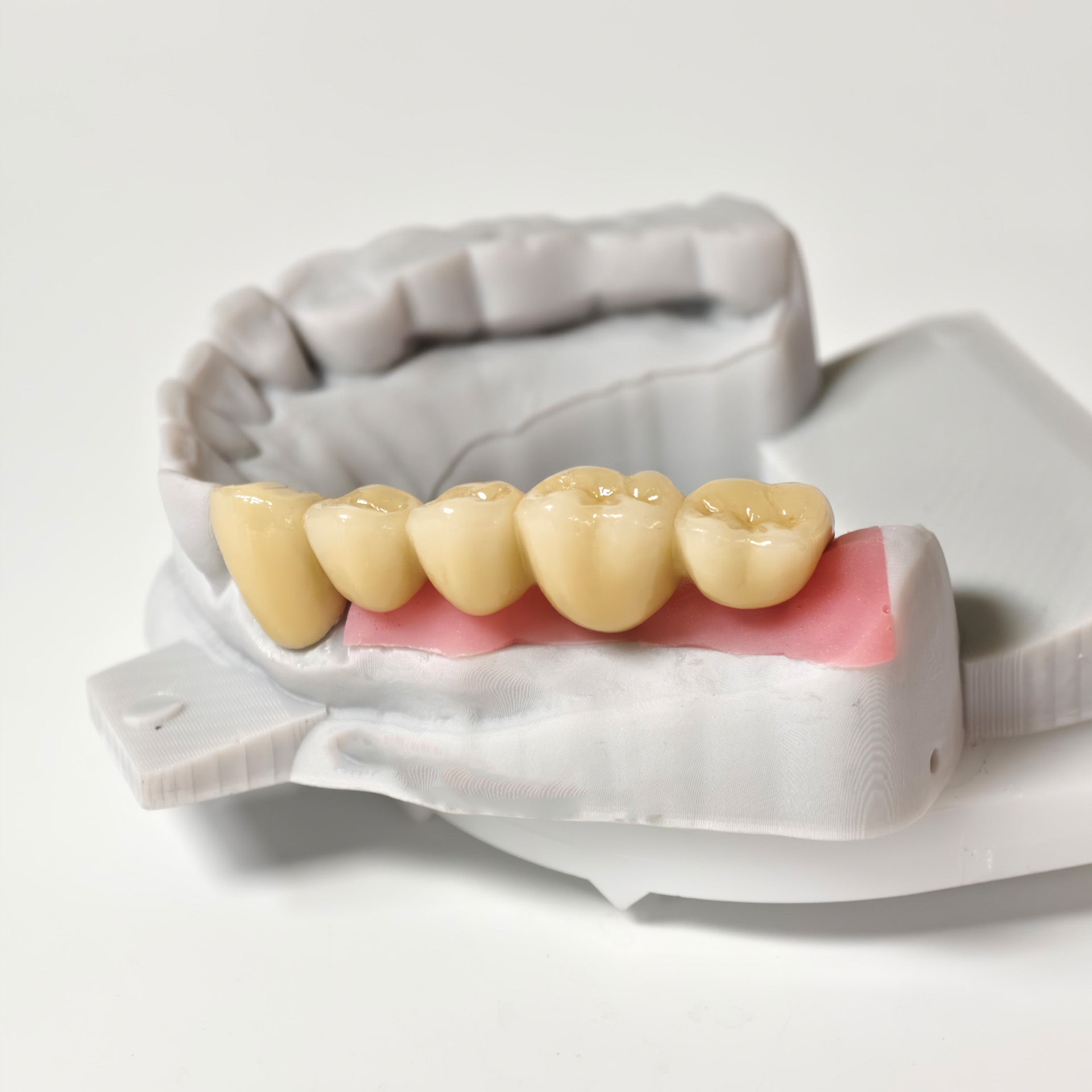 Implant-Supported PFM Single Bridge