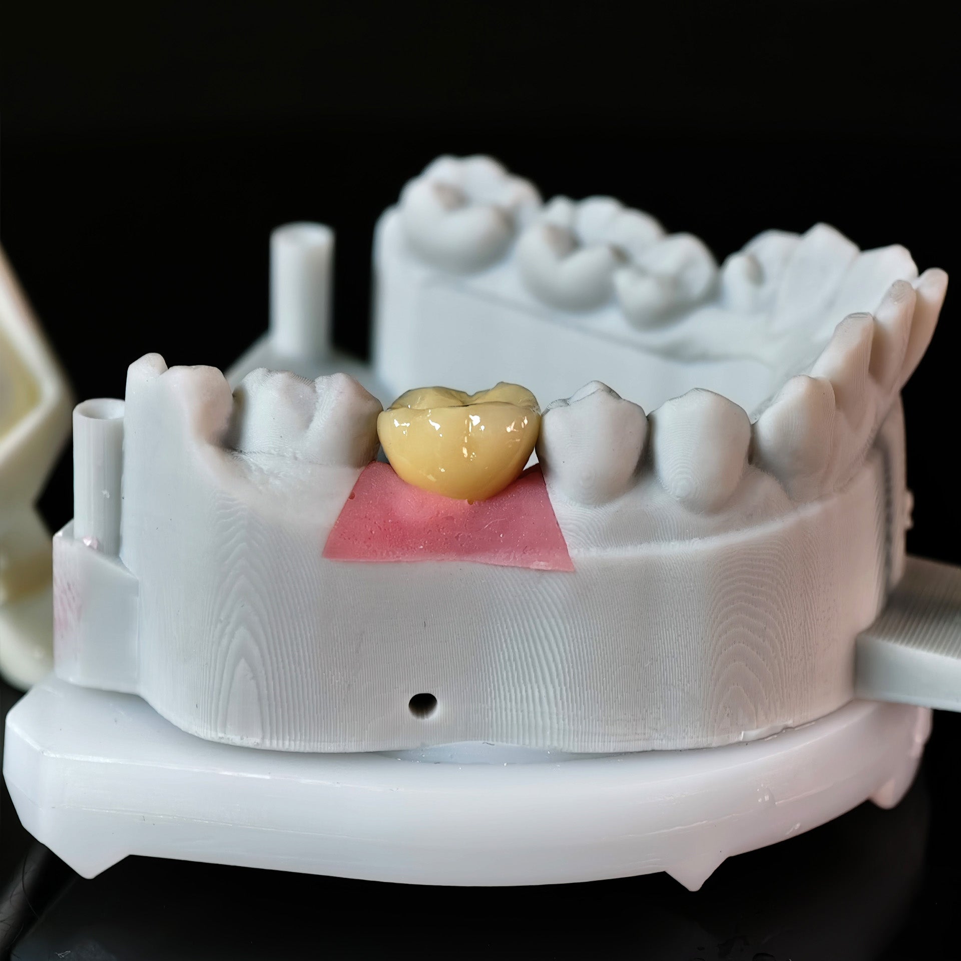 Implant-Supported PFM Single Crown