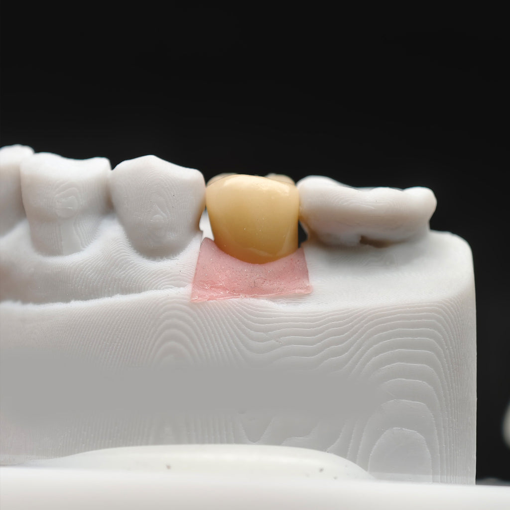 Implant-Supported PFM Single Crown