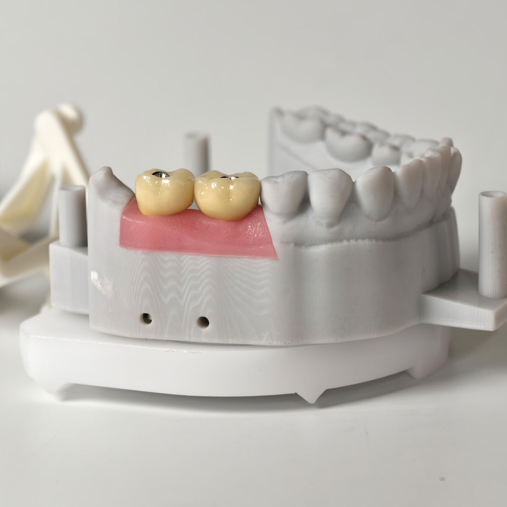 Implant-Supported PFM Single Crowns