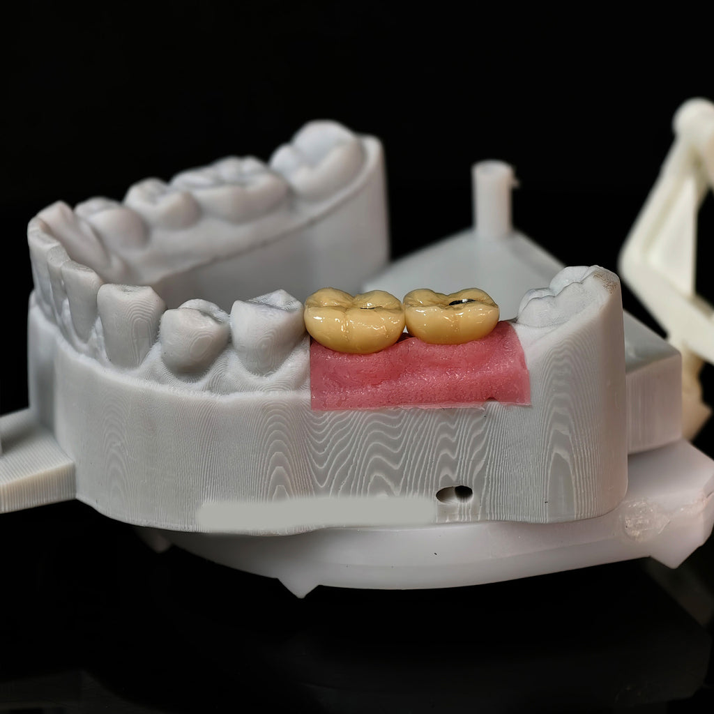 Implant-Supported PFM Single Crowns