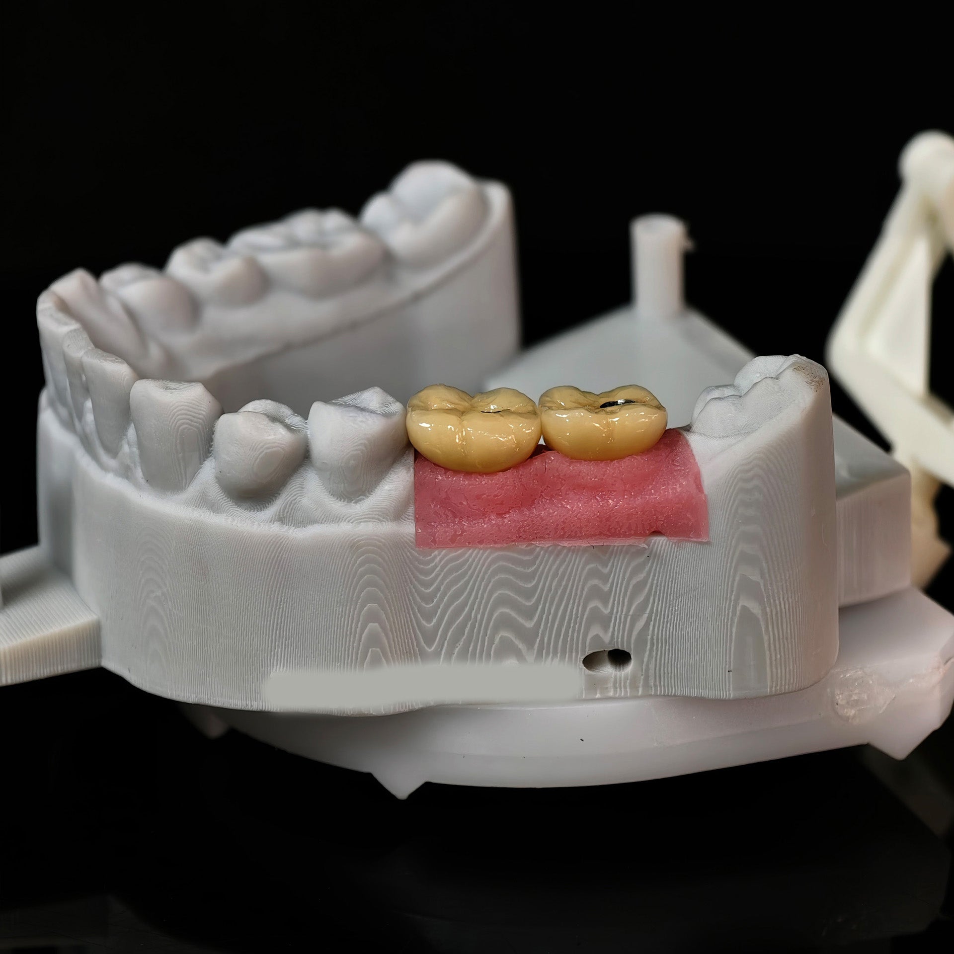 Implant-Supported PFM Single Crowns