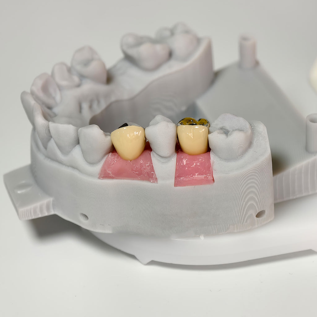 Implant-Supported PFM Single Crowns With Metal