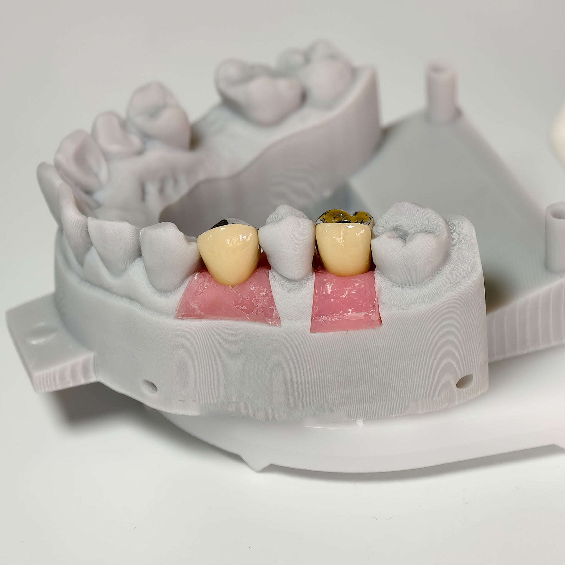 Implant-Supported PFM Single Crowns With Metal