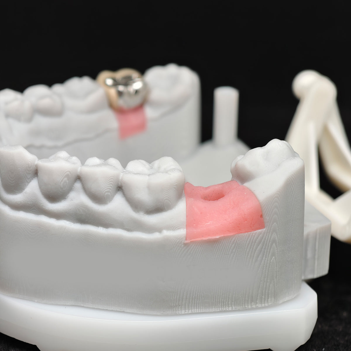 Implant-Supported PFM Single Crown With Metal