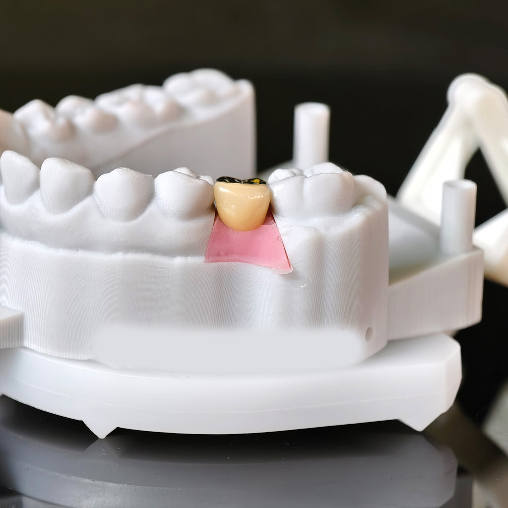 Implant-Supported PFM Single Crown With Metal