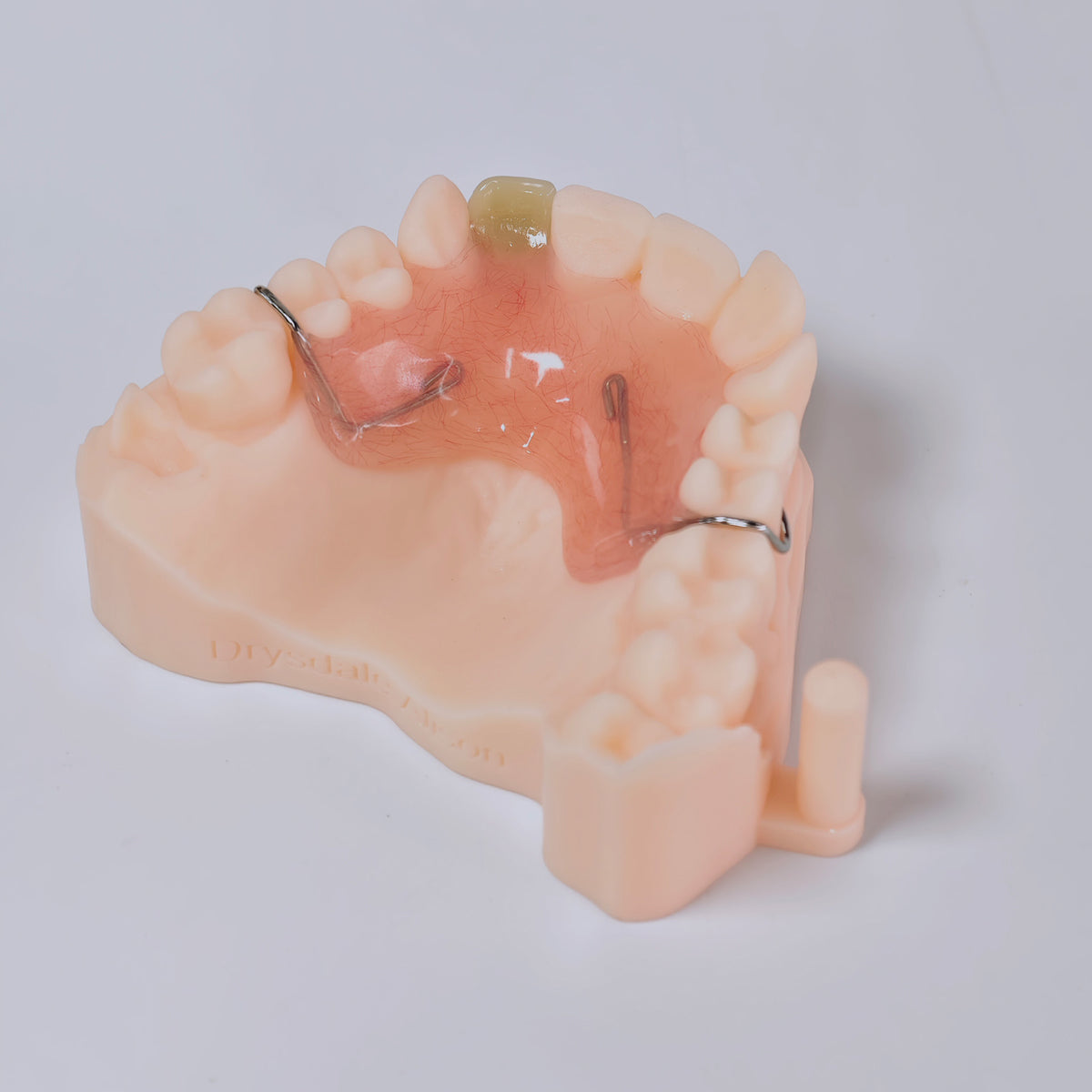 Metal Clasp Partial Denture