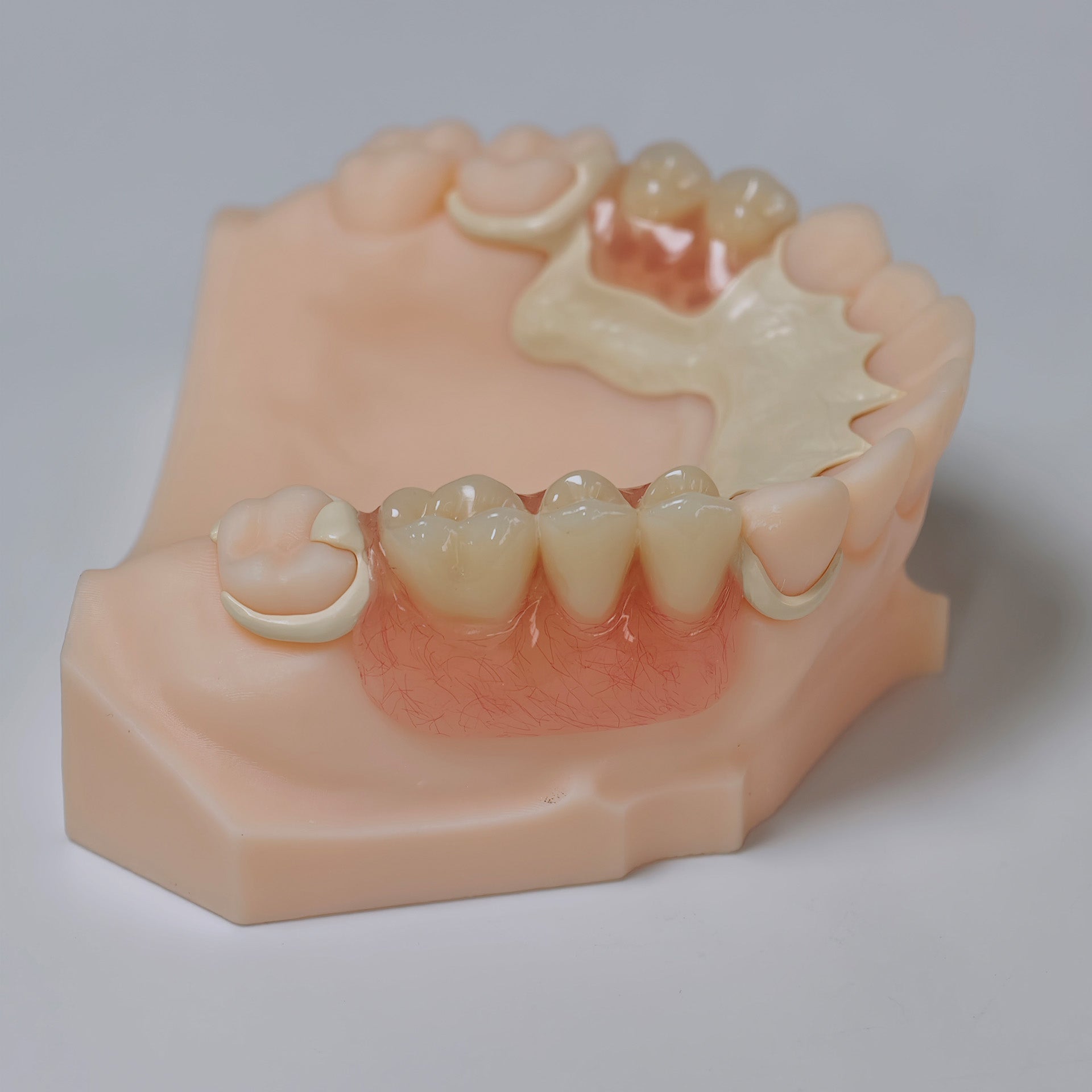 PEEK Framework Denture Metal Framework With Acrylic Denture