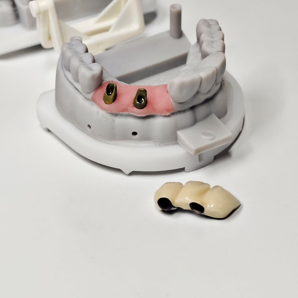 PFM Bridge With Screw-Retained And Implant Seating Guide