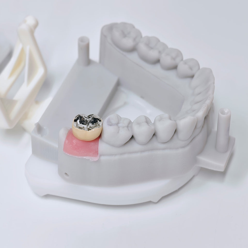 PFM Crown With Screw Retained