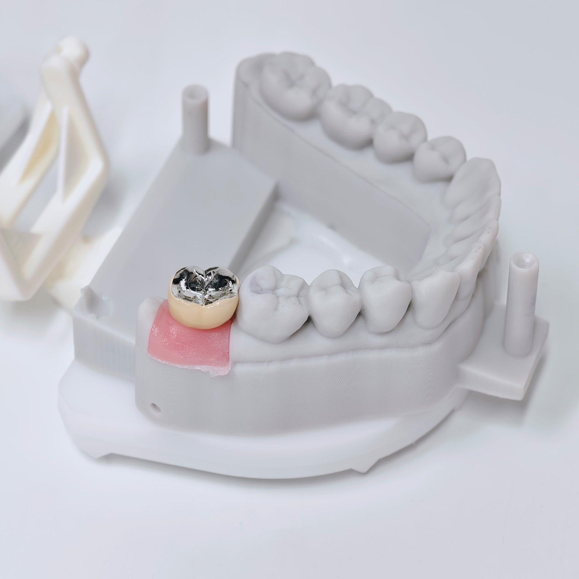 PFM Crown With Screw Retained