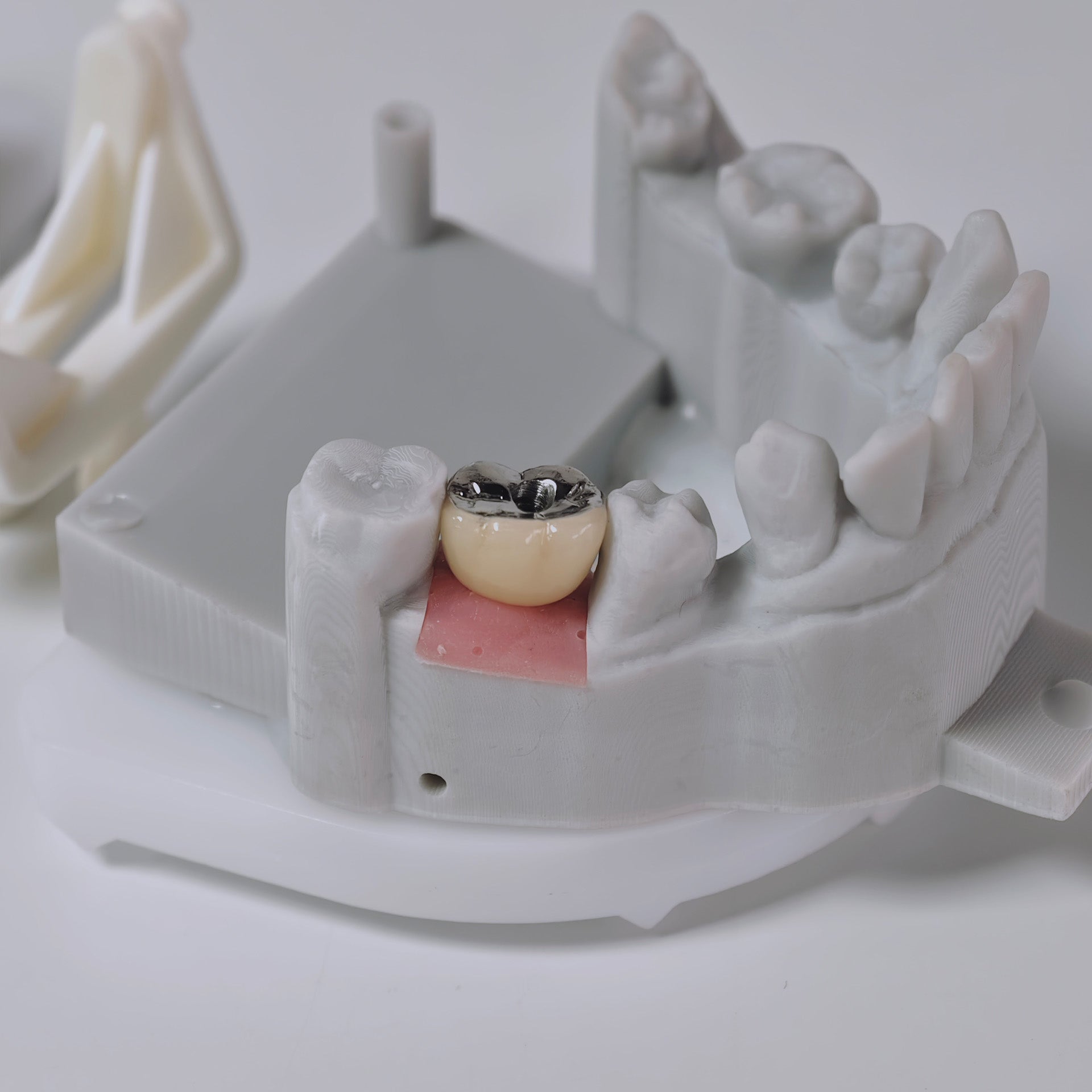 PFM Crown With Screw Retained