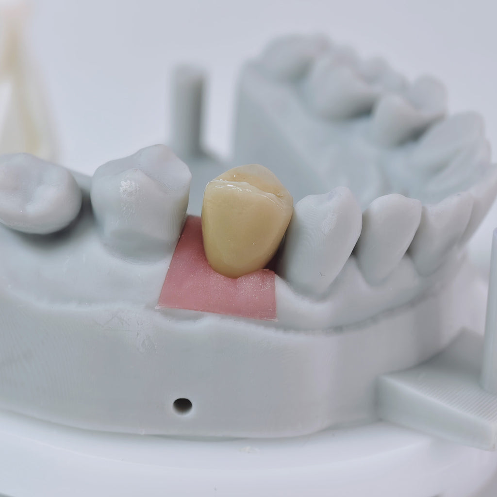 PFM Crown With Screw Retained
