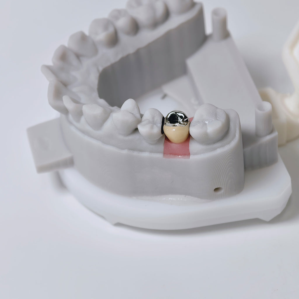 PFM Crown With Screw Retained