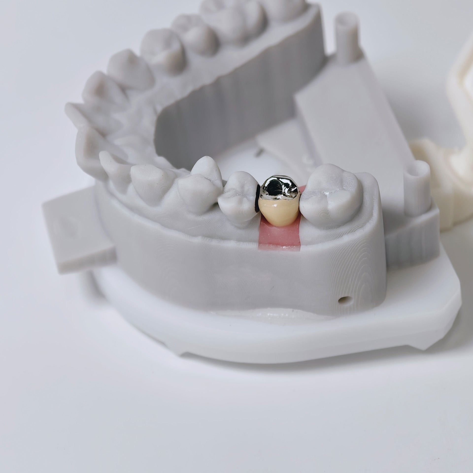 PFM Crown With Screw Retained