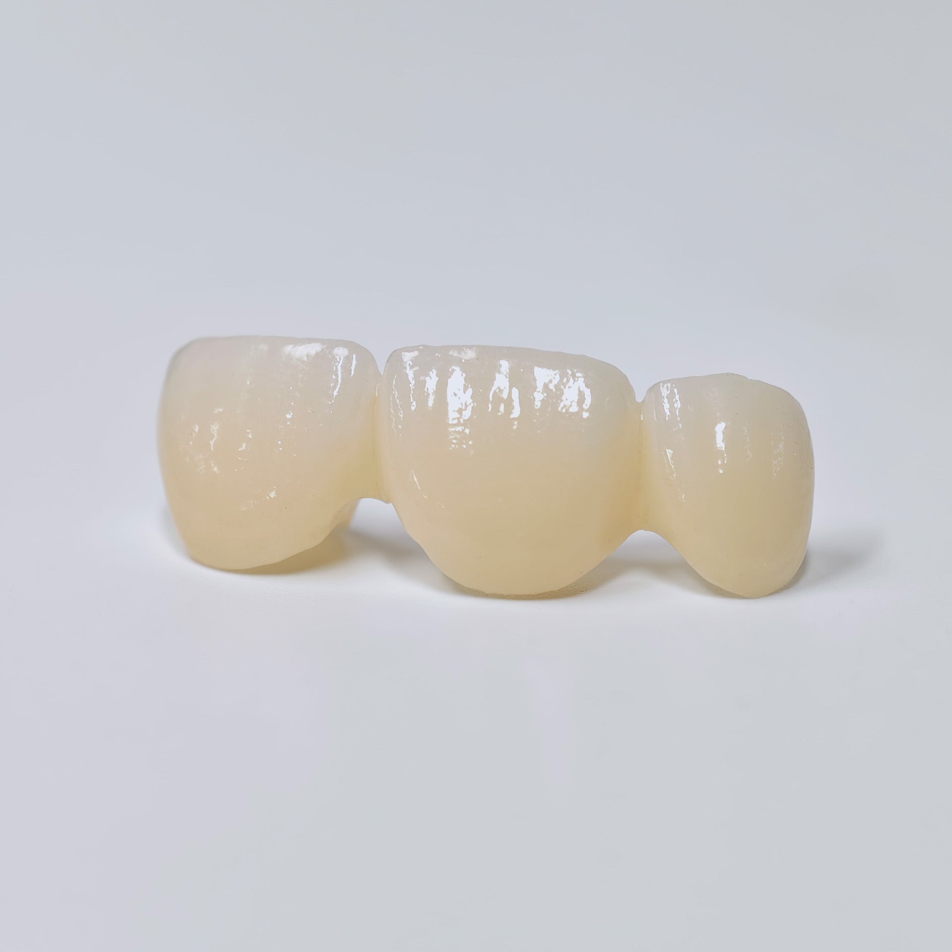 PFZ Dental Bridge – Depth And Aesthetics